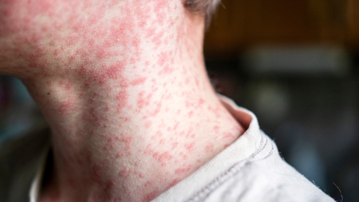 Victorians warned as overseas traveller infected with measles visits multiple locations [Video]
