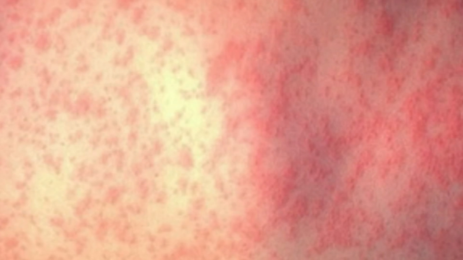 Measles outbreak 2024: CDC urges families planning to travel to get measles vaccine amid rise in cases in the US and globally [Video]