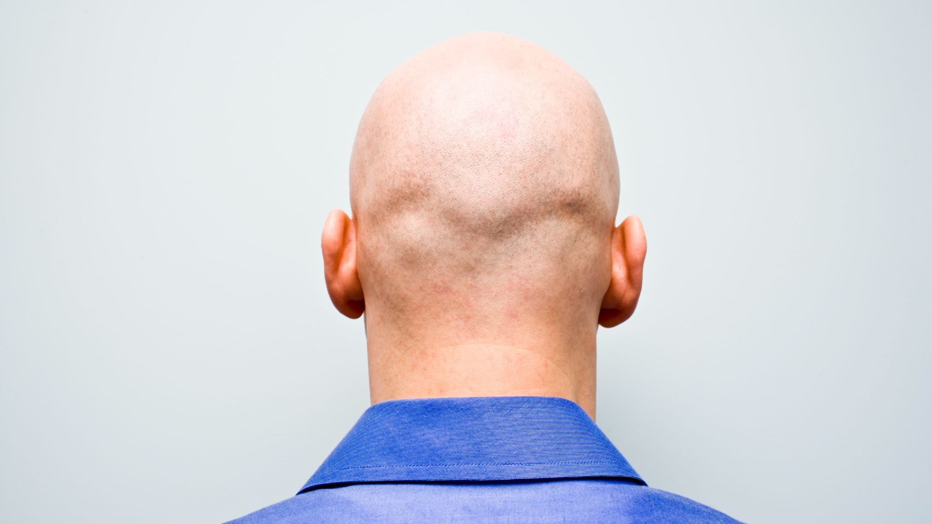 Baldness could be cured by a sugar that naturally occurs in the body, experts say [Video]